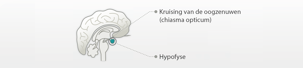 Hypofysetumor bij hersenen leidt tot acromegalie